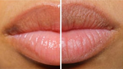 Remedios Para Labios Resecos