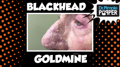 Dr Pimple Popper: A Goldmine of Blackhead & Whitehead Extractions