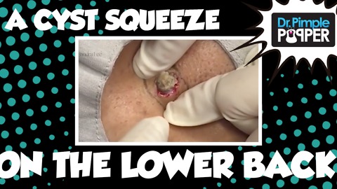 Dr. Pimple Popper: A Cyst Squeeze on the Lower Back