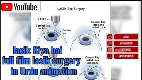 lasik kiya hai | lasik sugery | glasses se nijat | Transform Your Vision