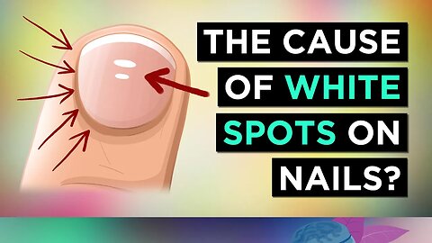 Do You Have White Spots On Your Nails? (Cause & Treatment)