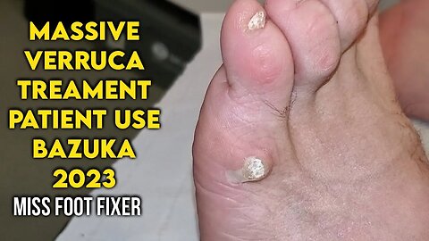 PATIENT MIGHT USING **BAZUKA** MASSIVE FOOT VERRUCA / WART TREATMENT BY PODIATRIST MISS FOOT FIXER