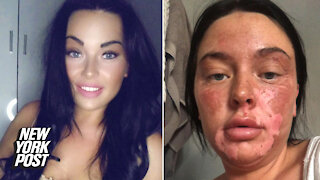 Botched TikTok egg hack leaves woman with 'poached' face