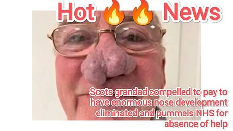 Scots grandad compelled to pay to have enormous nose development eliminated and pummels NHS for