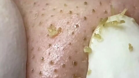 blackhead removal/extraction! Perfect zoom!