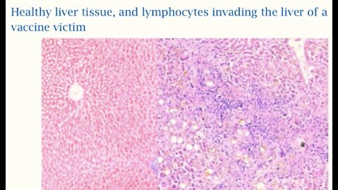 Vaccinee Autopsies: Killer Lymphocytes Invade Vital Organs, Drs Sucharit Bhakdi & Michael Palmer