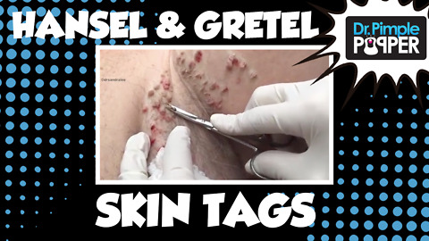 Hansel & Gretel Skin Tags with Dr Pimple Popper