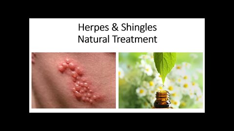 Herpes & Shingles Natural Treatment