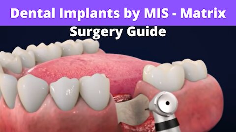 Dental Implants by MIS - Matrix Surgery Guide (3D Animation Dental Tutorial)