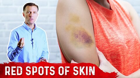What Causes Bruises on Legs & Arms? – Top 5 Causes of Bruising Covered by Dr.Berg