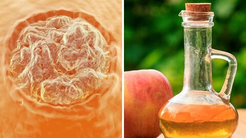 How to Remove Warts at Home Using Apple Cider Vinegar