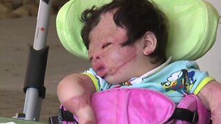 'Miracle baby' who survived fire, severe burns finally goes home