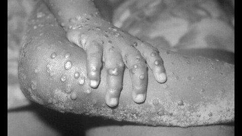 WHO Warns Monkeypox Could "Accelerate" During Summer, CDC Alerts US Doctors