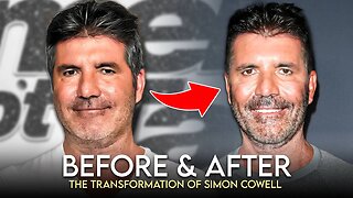 Simon Cowell | Before & After | What Happened To His Face?