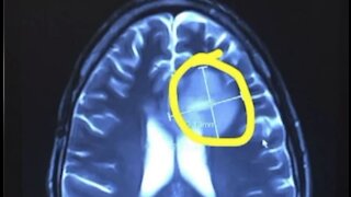 New help in glioblastoma fight