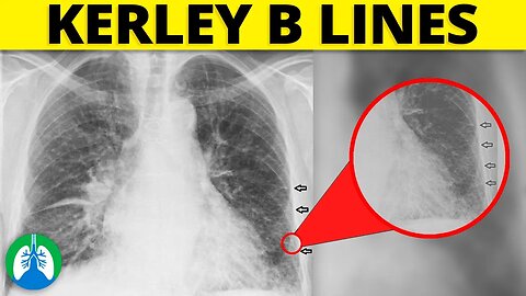 Kerley B Lines (Medical Definition) | Quick Explainer Video