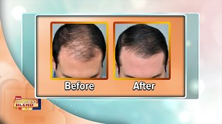 Hair Restoration With Swan Centers