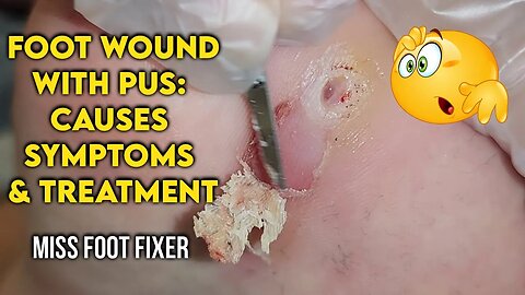 Foot Wound with Pus: Causes, Symptoms, and Treatment | By Foot Specialist Miss Foot Fixer