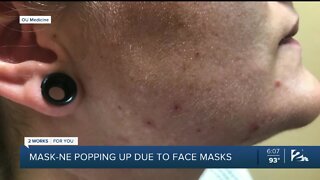 'Maskne' popping up due to face masks