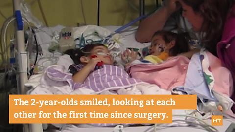 Formerly conjoined twin girls see each other for the first time since separation