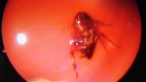 Doctors Find LIVE COCKROACH Squirming Inside Woman’s Skull
