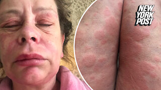 UK woman says AstraZeneca COVID-19 vaccine turned her into 'Alien' monster