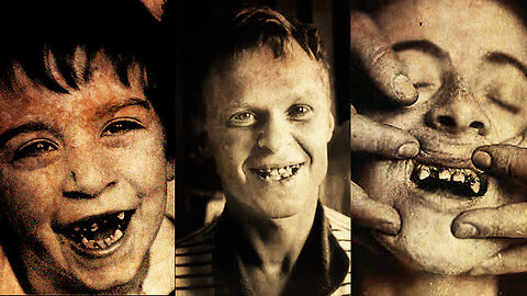 EVIL HUMAN Experiments Of The 1940's - TOOTH DECAY & SUGAR LINKED by Vipeholm Study...