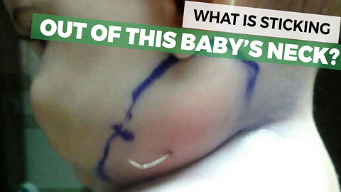 They Notice Object Coming Out Of Their Baby’s Neck, Baffled By Doctor’s Diagnosis
