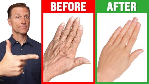 #1 Absolute Best Remedy for Dry and Wrinkled Hands