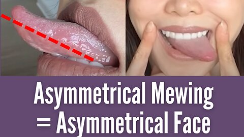 Asymmetrical mewing causes asymmetrical face