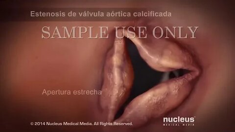 Implantación de válvula aórtica transcatéter - Enfoque transfemoral (TAVI)