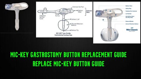 How to Change the Mic-Key Button G-tube mic-key gastrostomy button replacement