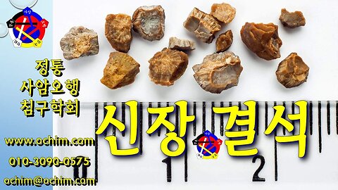 신장 결석 치료 방법 및 사례 - 비과학적 양의학 207 - 사암침, 사암침법, 정통사암침