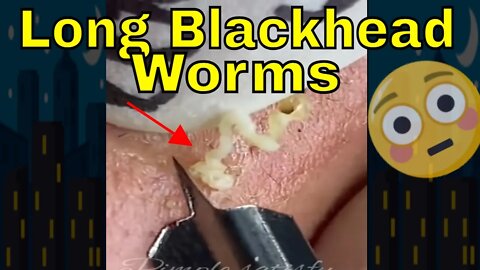 Long blackhead worms squeezed out 🪱 #blackheadremoval #blackhead #blackheads #blackheadsqueezing