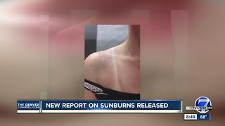 New report on sunburns released