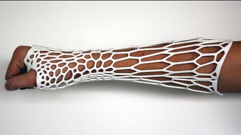 3D-printed Cortex Exoskeleton may be the future of orthopedic casts - TomoNews