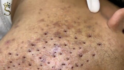 Removing Acne and Blackheads Treatment, #47
