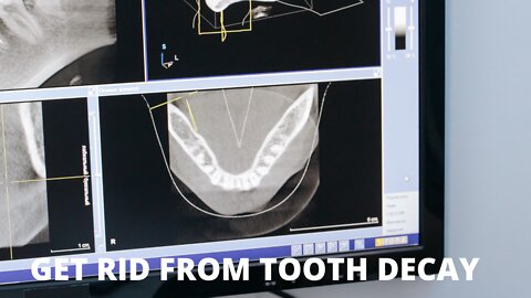 Get Rid of Tooth Decay Users Say It's Better Than Implants: