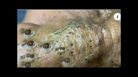Cystic Acne Extraction ,Blackheads Removal,Blackhead Extractions