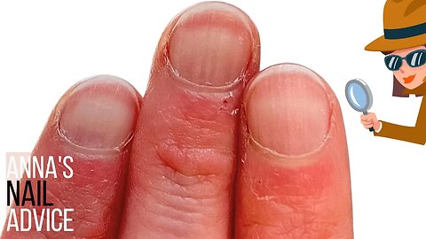 Getting impatient with THIS SKIN around the nails?