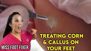 Treatment Of Hard Skin Callus and Corn on Your Feet by Famous Podiatrist Miss Foot Fixer