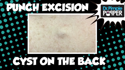 Punch removal of a Cyst on back