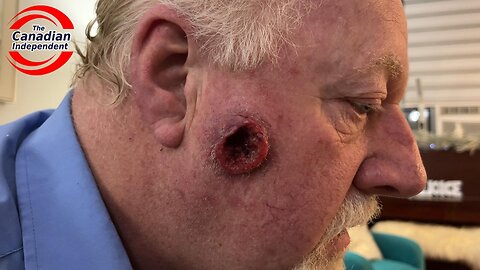 Ontario Man with a Massive Gaping Hole on the Side of His Face Struggles to Obtain Prompt Healthcare