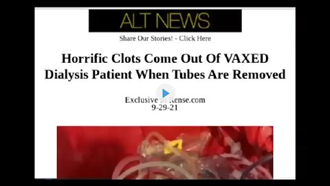Horrific Blood Clots Come Out of VAXXED Dialysis Patient When Tubes Are Removed