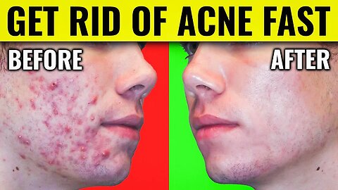 Say Goodbye to Acne: Dr. Berg's Proven Methods for Clearing Your Skin