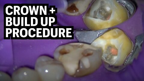 Build Up + Crown Procedure {Tooth Cavity Removed w/ Rubberdam)