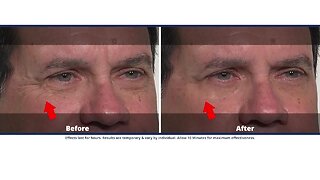 Reverse The Signs Of Aging With Plexaderm
