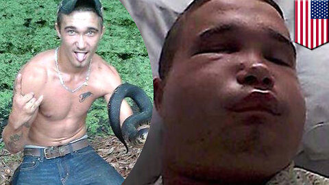 Deadly snake bites man trying to kiss it, venom almost kills him, leaves his face swollen - TomoNews