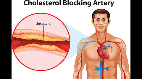 Would High LDL Really Give You A Heart Attack?