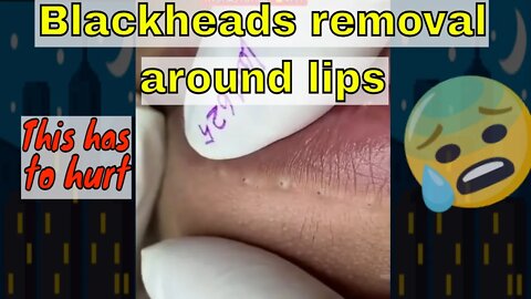 This has to hurt 😢 blackheads removal around lips #blackheadremoval #blackhead #blackheads #fypage